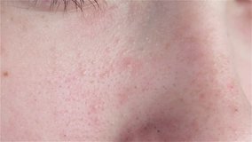 Acne and black spots on the face of a young girl. Problem skin. Teenage skin. Macro Video.