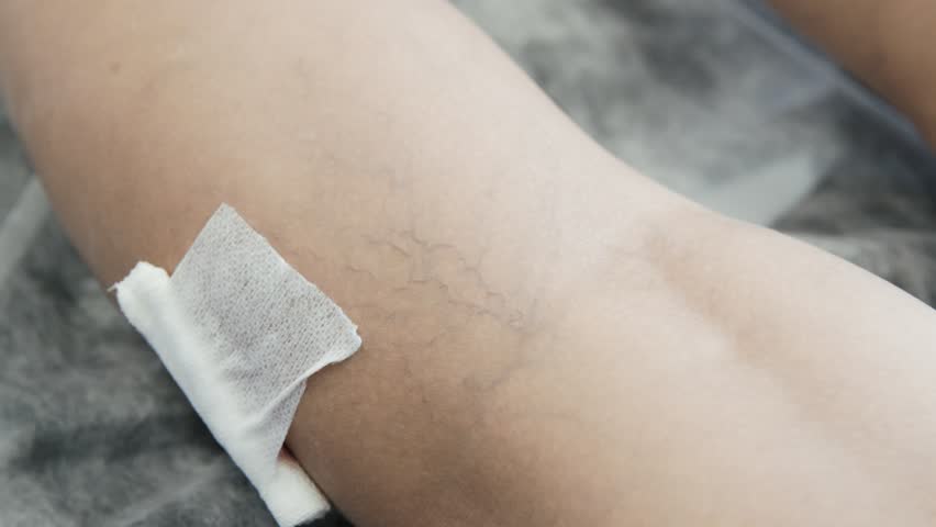 Close-up hands of phlebologist in gloves does procedure of sclerotherapy on leg of patient. Doctor injects special substance with syringe into vein and put bandage on. Treatment of varicose veins. Royalty-Free Stock Footage #1027035677