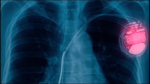 x-ray footage pacemaker cell, electrically charged medical device for abnormal heartbeat