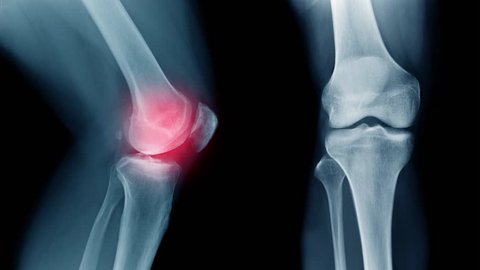 x-ray knee joint show OA knee and pain in joint