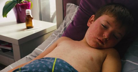 Viral disease. Measles rash. Child with viral infection measles lies in the bed and scratches himself. Coronavirus, crownvirus, covid-19