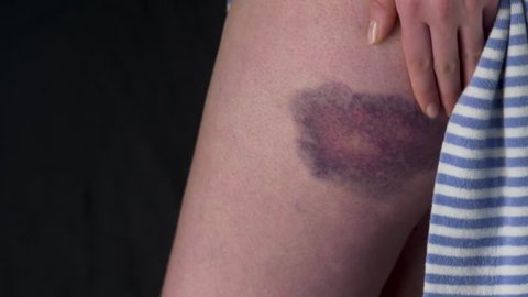 Woman Bruise Hematoma On Thigh Leg Stock Footage Video 100 Royalty Free 1027522208 Shutterstock