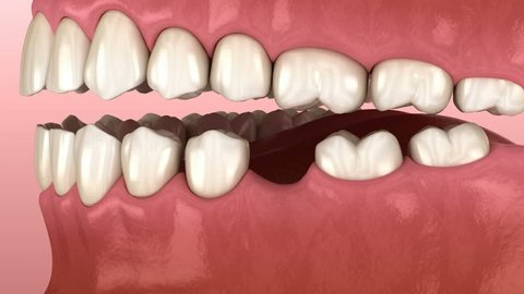 Teeth shift deformatiuon after losing molar tooth. 3D animation of Popov Godon phenomenon