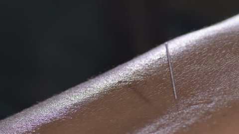 Acupuncturist spikes an acupuncture needle in a acupuncture session