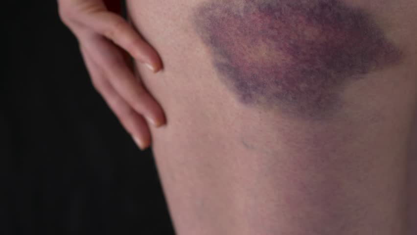 Thigh bruise Stock Video Footage - 4K and HD Video Clips Shutterstock 
