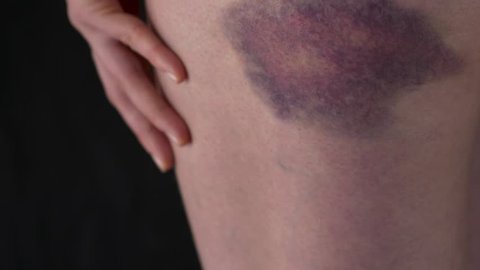 The bruise on the body of woman hematoma on the thigh leg of a female skin hit injury violence bruise fall beat part of human body hand closeup isolated black background.