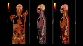 Positron Emission Tomography or PET CT Scan of Whole Human Body (Loop Recording)