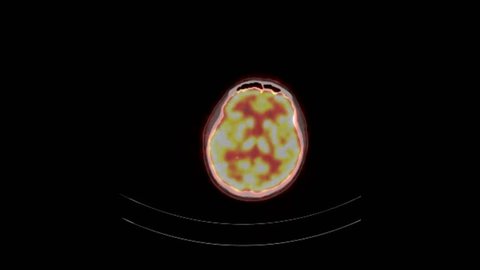 Positron Emission Tomography or PET CT Scan of Whole Human Body (Loop Recording)