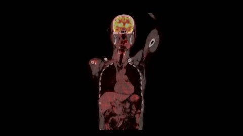 Positron Emission Tomography or PET CT Scan of Whole Human Body (Loop Record)