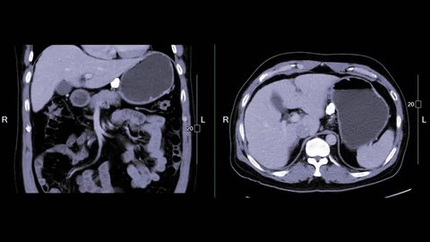 CT Upper Abdomen comparison Coronal and Axial view showing small liver mass (Arrow).