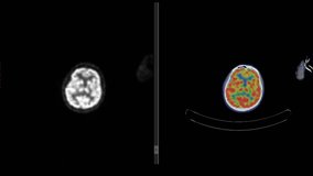 Scintigraphy and Positron Emission Tomography or PET CT Scan of Whole Human Body (Loop Record)