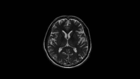 mri scan brain normal