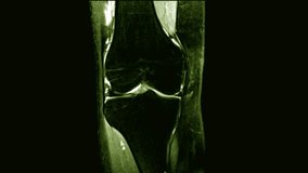 Knee MRI (Magnetic Resonance Imaging) Loop Record