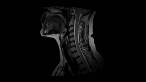 Cervical MRI Scan (Magnetic Resonance Imaging)