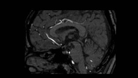 Brain MRI Scan (Magnetic Resonance Imaging)  Ultra HD 4k, Time Lapse, Loop Record