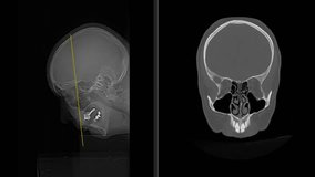 CT scan of Paranasal Sinuses (Computed Tomography) Loop Record 4k-HD