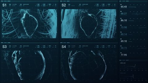 A beating heart is displayed on a high tech screen as it is monitored for a cardiologist with heart rate, blood pressure and other data Stockvideo