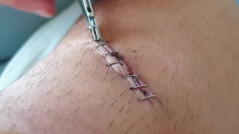 Removing the metal staples (saturates) on one knee with the grapple remover