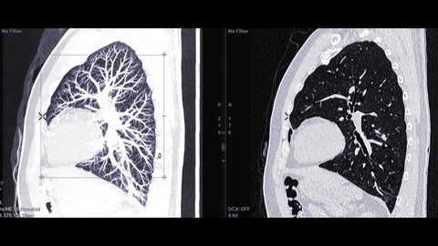 CTA Chest with contrast media comparison Sagittal MIP and sagittal 2D for diagnostic Pulmonary embolism (PE) and lung cancer .