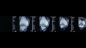 Zoom-in video of R.M.N. Nuclear magnetic resonance, of human knees, with cross-section and sagittal section.