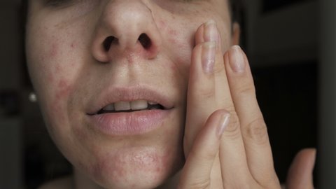 woman with a Allergy on the face, dermatitis