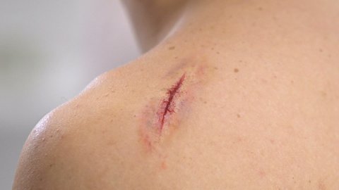 Nurse applying adhesive bandage on scratched shoulder, knife wound, close-up