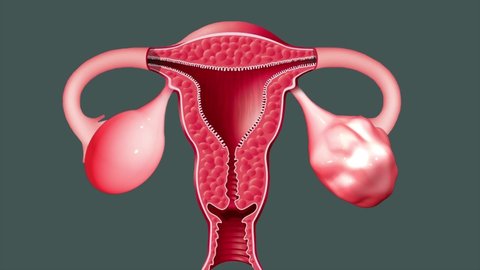 uterus PCOS, Most ovarian cancers start in the epithelium, or outer lining, of the ovary.