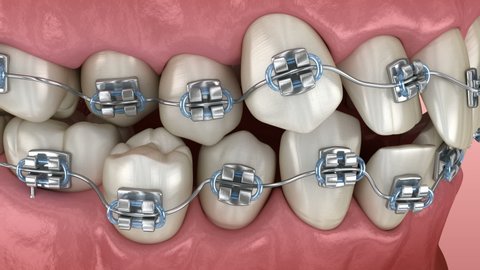Abnormal teeth position and correction with metal braces tretament. Medically accurate dental 3D animation