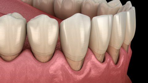 Gum recession process. Medically accurate 3D animation