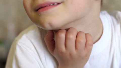 Close-up of allergic spot on the little boy's neck, he scratches his neck with his hand. Slow motion. Allergic reaction.