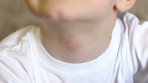 A little boy scratches a red inflamed spot on the skin of the neck, atopic dermatitis in a child. Close-up. Slow motion. Allergic reaction.