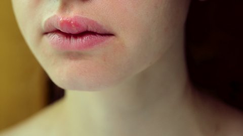 Herpes on the Upper Lip of a Young Woman. Medical Background of a Young Beautiful Woman with Herpes Labialis. Herpes Simplex Virus