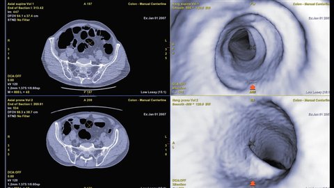 CT colonography compare Axial and 3D movie file for screening colorectal cancer. Check up Screening cancer of colon.