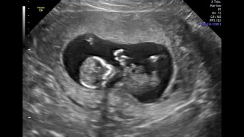 Ultrasound of Baby - 12 Weeks