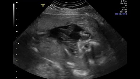 Ultrasound of Baby - 20 Weeks