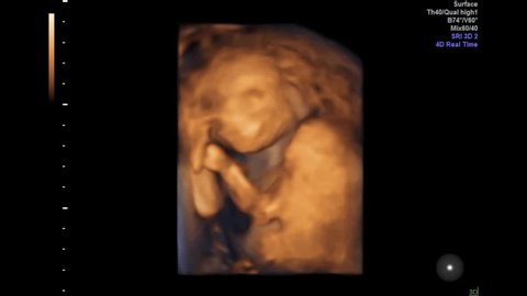 A 4d Ultrasound Of A Video De Stock 100 Libre De Droit Shutterstock