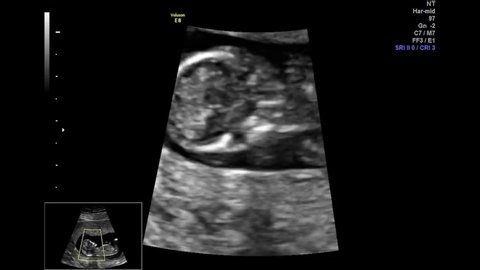 Ultrasound Small Baby 12 Weeks Video De Stock 100 Libre De Droit Shutterstock