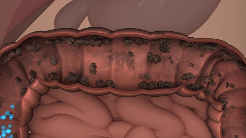 Intestinal toxin,Intestinal accumulation toxin,cleans the intestines,digestive process,human stomach,human colon,human stomach,large intestine,Anatomy of the human digestive system Royalty-Free Stock Footage #1031605388