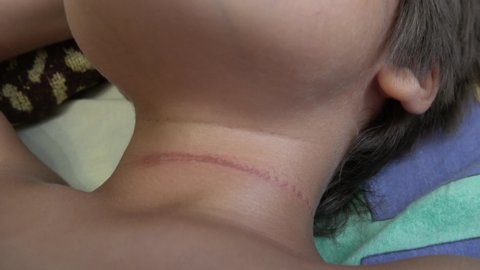 4K Kid with a sore mark on his neck after accident, crystal child
