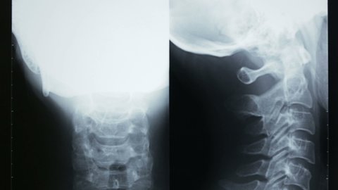 Vertical shot of a radiograph of the cervical bones and of the human skull