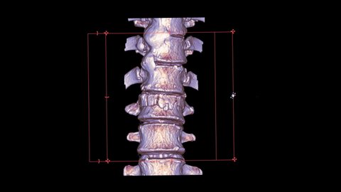 CT Scan of T-L spine or thoracolumbar junction spine 3D rendering image turn around on the screen showing fracture L1 spine.