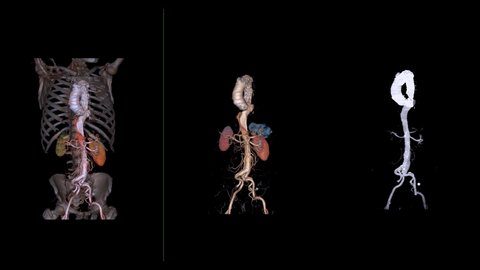 CTA abdominal aorta 3D rendering image with transparent skeletal ,3D aorta only and 3D aorta MIP showing of aortic dissection.