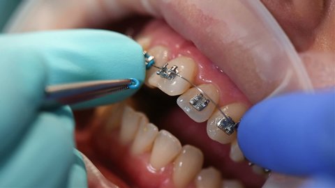 Dentist Puts On Fixing Gum On Braces In Denal Clinic. Extreme Close Up