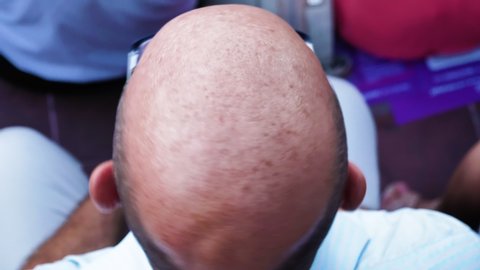 man without hair on top have baldness