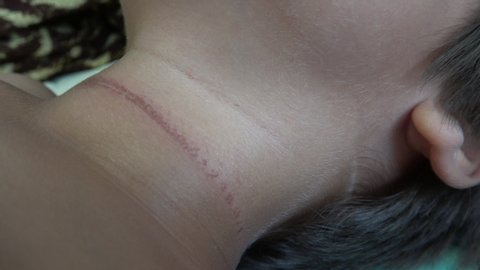 4K Close up a deep scratch mark on childs neck
