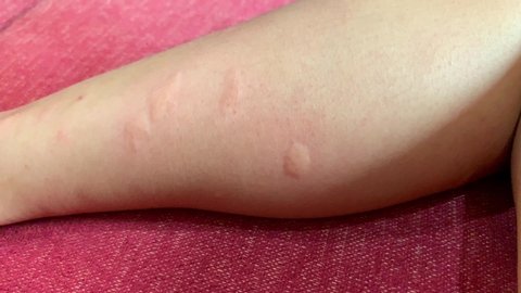 Young woman scratch her leg. Many bites of insect, bed bugs, mosquito or flea. Health care beauty concept. 