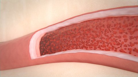 Artery Clogging with the Cholesterol Plaque