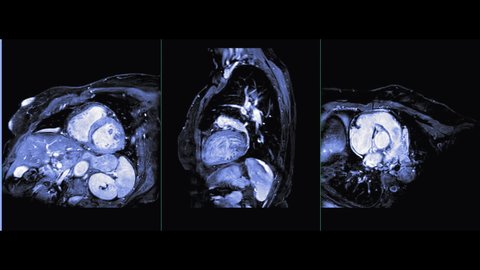 MRI heart or Cardiac MRI ( magnetic resonance imaging ) of heart in cardiac plane showing heart working for detecting heart disease.