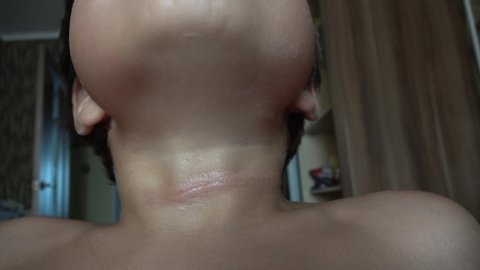 4K Neck of child with a sore mark like after rope
