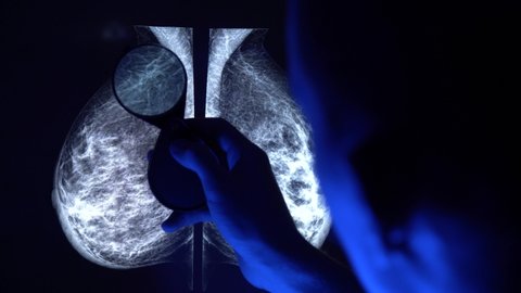 Doctor with magnifying glass checking mammogram x-ray. Mammography diagnostic to prevent breast cancer. 4k close up video